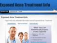 exposedacnetreatmentinfo.com